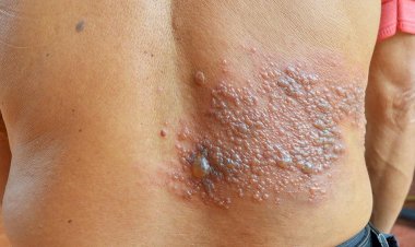 Herpes zóster, causado pelo vírus da catapora, pode ser prevenido com vacinação