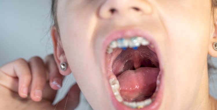 Prevenção e detecção precoce contribuem para reduzir incidência e mortalidade de câncer de boca