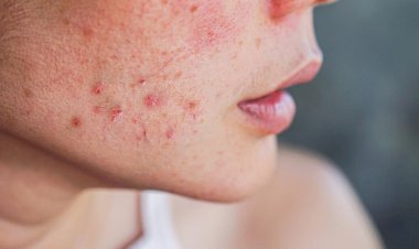Acne: profissional da Unesc explica causas, efeitos e tratamentos eficazes